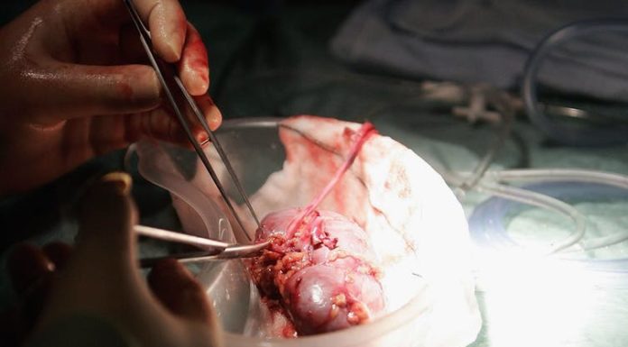 How the airline industry recovers from COVID-19 could determine who gets organ transplants