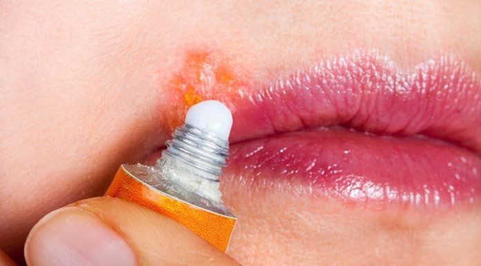 What Is Genital Herpes? Symptoms, Causes, Diagnosis, Treatment, and Prevention