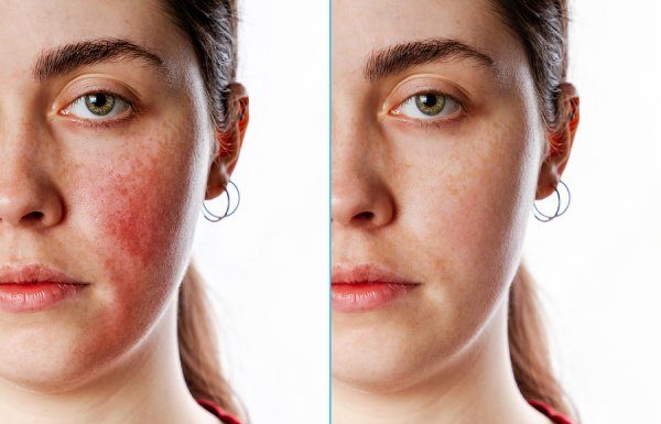 How to Get Rid of Rosacea: 7 Rosacea Remedies That Work