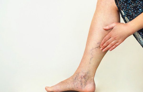 How to Get Rid of Varicose Veins: 9 Home Remedies That Work