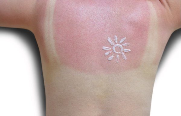 Too Much Sun! 8 Natural Sunburn Remedies That Work Fast
