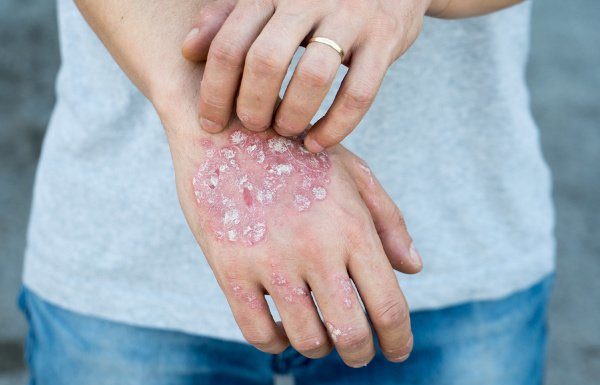How to Get Rid of Psoriasis: 9 Tips and Remedies to Try