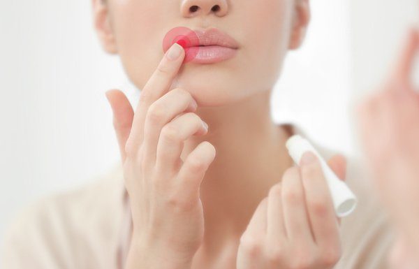Fast and Effective: 12 Natural Cold Sore Remedies that Work