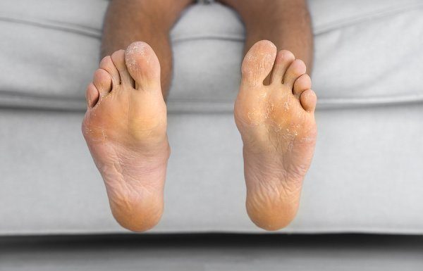 Tinea Pedis: 7 Remedies for Athlete’s Foot to Ease Symptoms