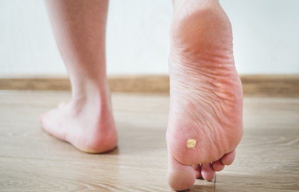 Home Remedies that Work: 7 Natural Treatments for Plantar Warts