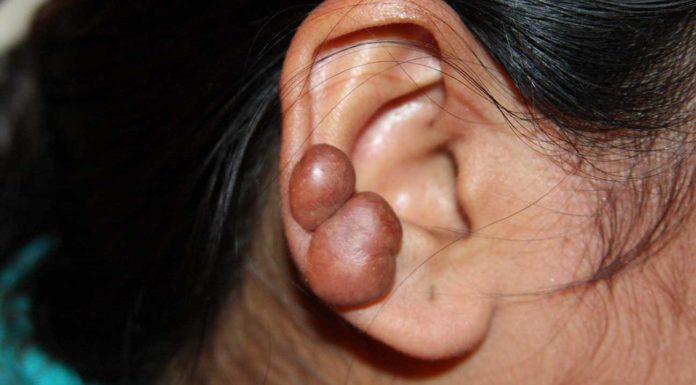 What Are Keloids? Symptoms, Causes, Diagnosis, Treatment, and Prevention