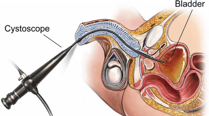 What Is a Cystoscopy?