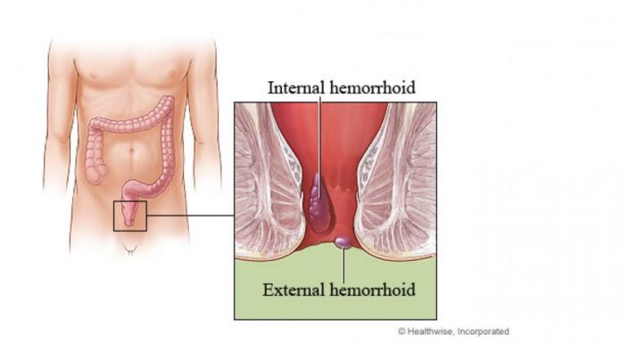 What Is a Hemorrhoidectomy?