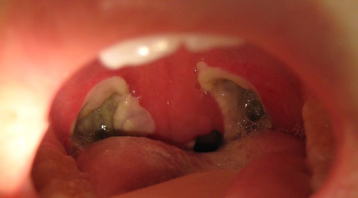 What Is a Tonsillectomy?