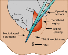 What Is an Episiotomy?