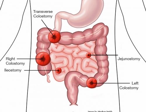 What Is an Ileostomy?