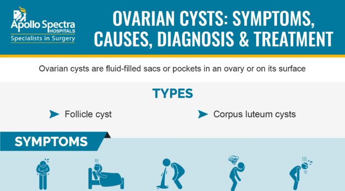 What Is an Ovarian Cyst? Symptoms, Causes, Diagnosis, Treatment, and Prevention