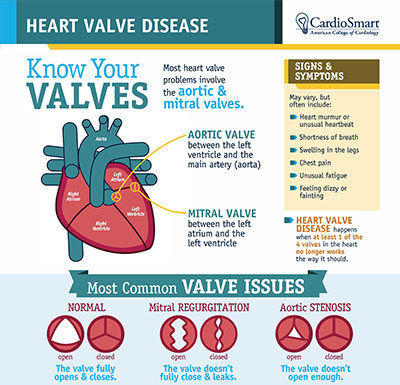 What Is Aortic Stenosis? Symptoms, Causes, Diagnosis, Treatment, and Prevention