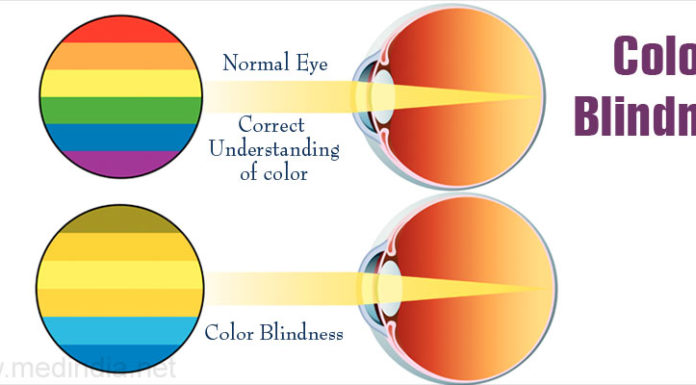 What Is Color Blindness? Symptoms, Causes, Diagnosis, Treatment, and Prevention