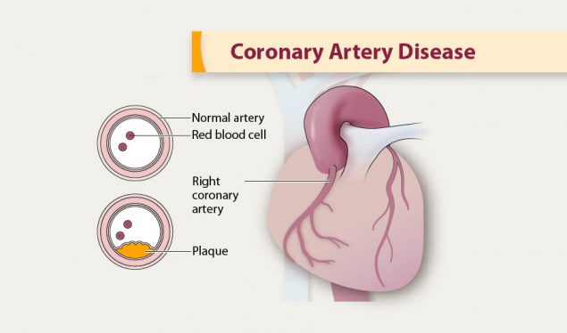 What Is Coronary Artery Disease (CAD)?