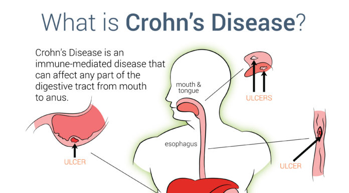 What Is Crohn’s Disease? Symptoms, Causes, Diagnosis, Treatment, and Prevention