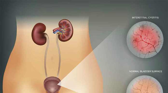 What Is Cystitis? Symptoms, Causes, Diagnosis, Treatment, and Prevention