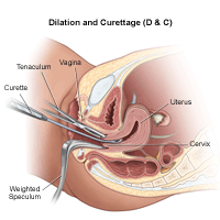 What Is Dilation and Curettage (D&C)?