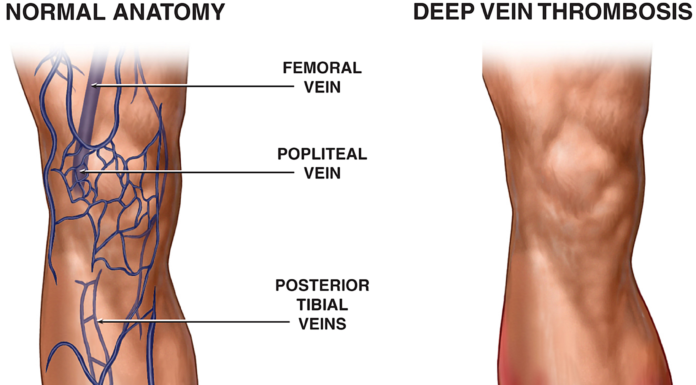 What Is DVT (Deep Vein Thrombosis)? Symptoms, Causes, Diagnosis, Treatment, and Prevention