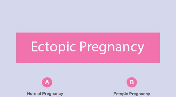 What Is Ectopic Pregnancy? Symptoms, Causes, Diagnosis, Treatment, and Prevention