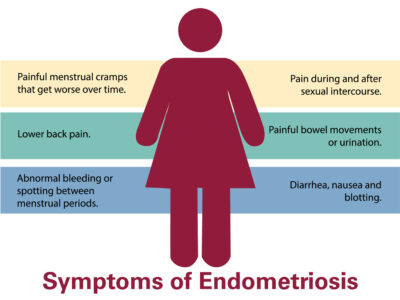 What Is Endometriosis? Symptoms, Causes, Diagnosis, Treatment, and Prevention