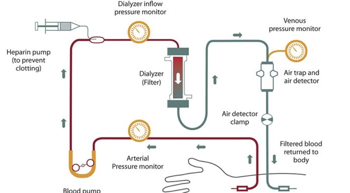 What Is Hemodialysis?