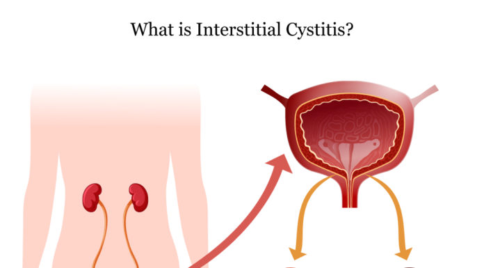 What Is Interstitial Cystitis? Symptoms, Causes, Diagnosis, Treatment, and Prevention