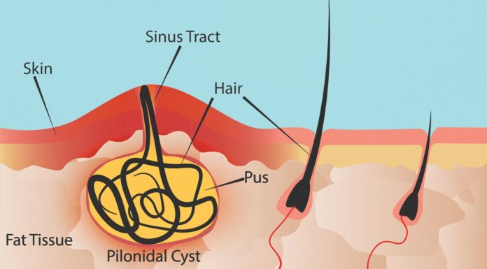 What Is Lipoma? Symptoms, Causes, Diagnosis, Treatment, and Prevention