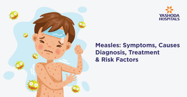 What Is Measles? Symptoms, Causes, Diagnosis, Treatment, and Prevention