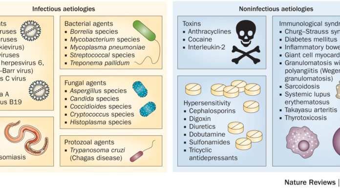 What Is Myocarditis? Symptoms, Causes, Diagnosis, Treatment, and Prevention