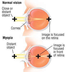 What Is Myopia (Nearsightedness)? Symptoms, Causes, Diagnosis, Treatment, and Prevention