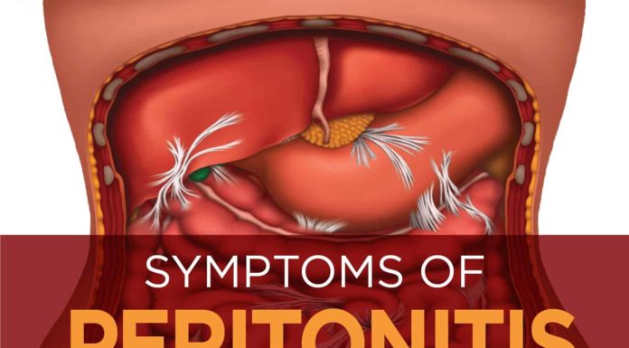 What Is Peritonitis? Symptoms, Causes, Diagnosis, Treatment, and Prevention