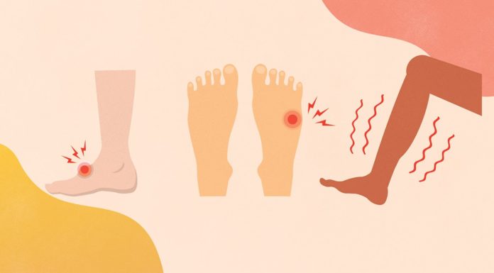 What Is Plantar Fasciitis? Symptoms, Causes, Diagnosis, Treatment, and Prevention