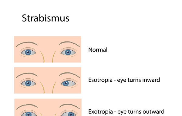 What Is Strabismus (Crossed Eyes)? Symptoms, Causes, Diagnosis, Treatment, and Prevention