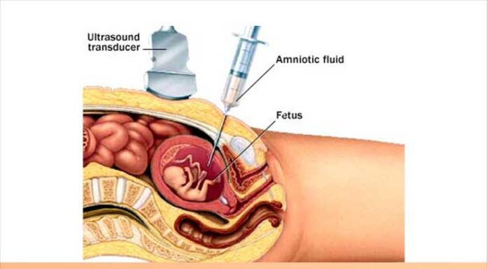 What Is Turner Syndrome? Symptoms, Causes, Diagnosis, Treatment, and Prevention